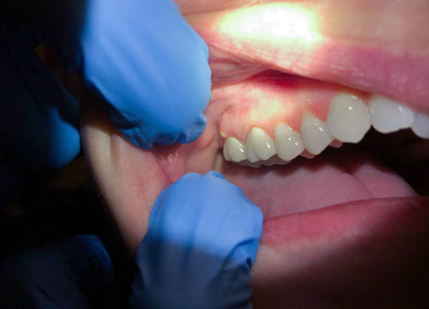 Best Emergency Treatment for Dental Infections or Abscesses in Carlyss, LA