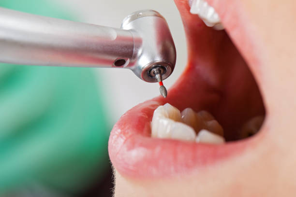 Best Emergency Dental Care for Broken or Chipped Teeth in Carlyss, LA
